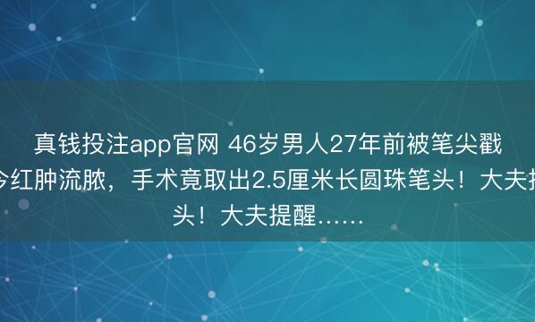 真钱投注app官网 46岁男人27年前被笔尖戳眼，如今红肿流脓，手术竟取出2.5厘米长圆珠笔头！大夫提醒……